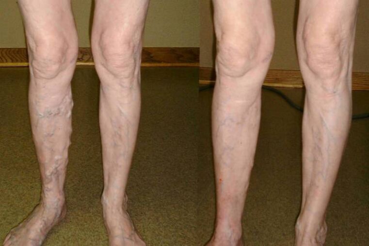 venas varicosas en hombres