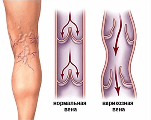 varices
