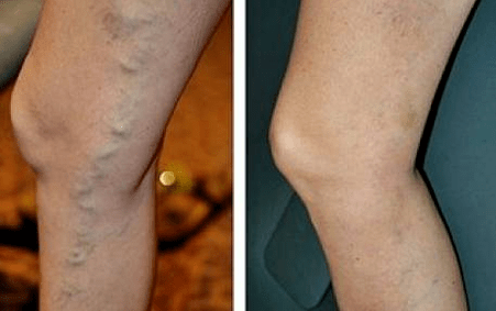 venas varicosas antes y después