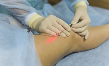 Tratamiento de las venas varicosas con un láser