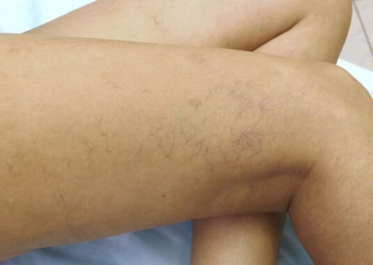 Estrellas vasculares