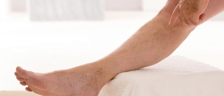 Venas varicosas en las piernas